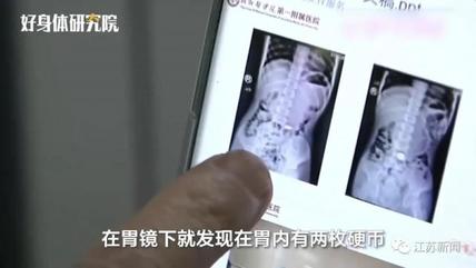 11岁男孩春节吃饺子吞下2枚硬币，1年后才取出！