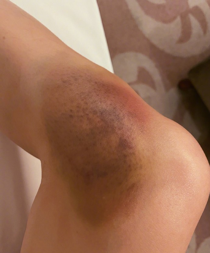 张馨予晒腿部淤青照笑侃现在跳舞我也有调色盘