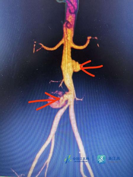 腹主动脉瘤的症状图片