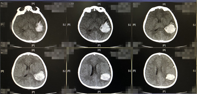 7岁男童荡秋千摔跤致颅内大出血 紧急送医抢救！休闲区蓝鸢梦想 - Www.slyday.coM