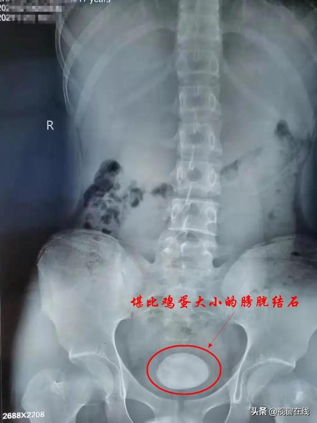 膀胱结石堪比鸡蛋看井陉县医院泌尿外科如何成功取出