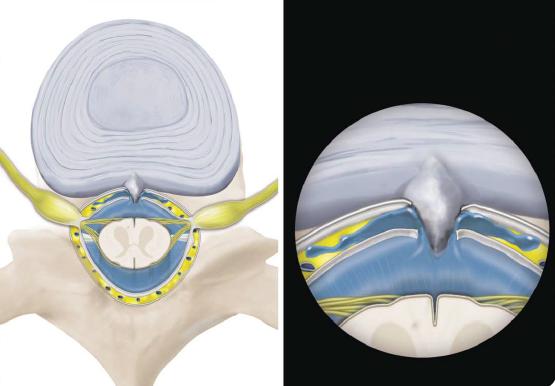 骨刺刺破硬脊膜,导致脑脊液外漏的示意图
