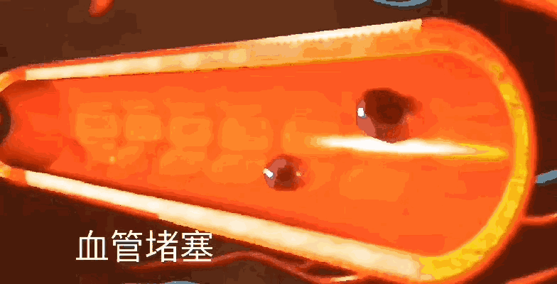 动脉粥样硬化_新浪新闻