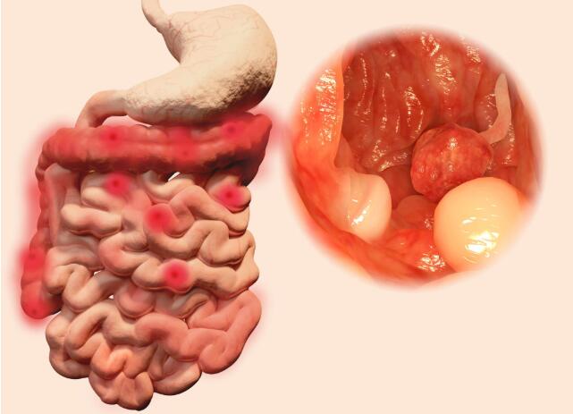 以下这些部位长出息肉时,就需要注意了,应立即切除