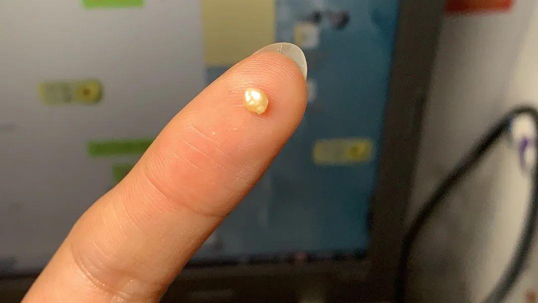 疼了10分钟左右,再照镜子,泪阜肿得更大了.