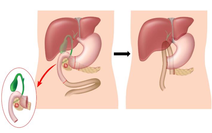 如果身体以下四个部位发现息肉,那尽早切除就很有必要