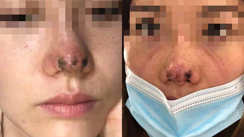 深圳:一女子玻尿酸隆鼻失败皮肤溃烂,向富华美容医院索赔25万余元