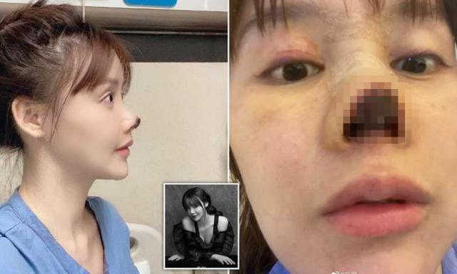 国内女星高溜整容后鼻头坏死引爆外国网友关注整容之前已很美