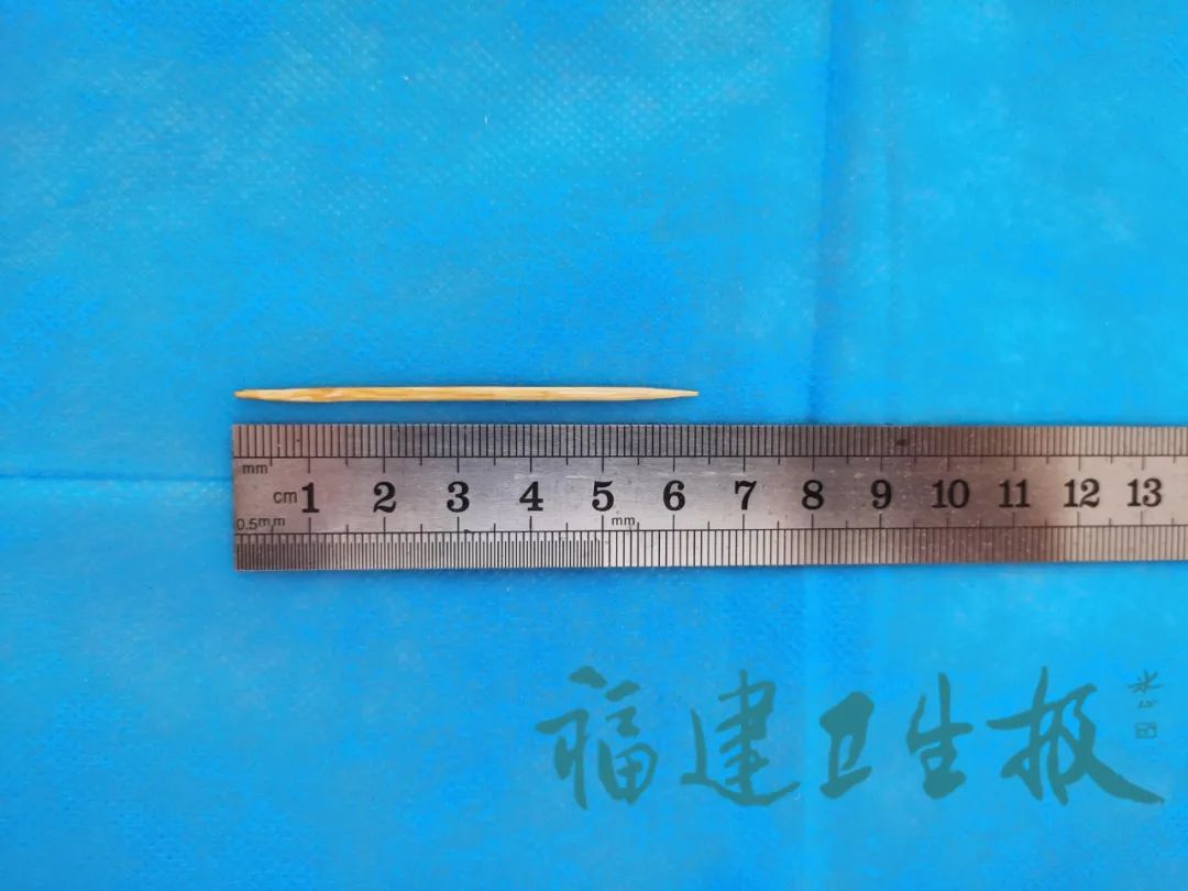 女子误吞63厘米牙签就医时已插入肝脏就因为这个小习惯很多人都有