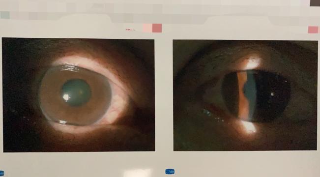 又叫原发性闭角型青光眼,这种青光眼发作时眼睛充血发红,瞳孔散大