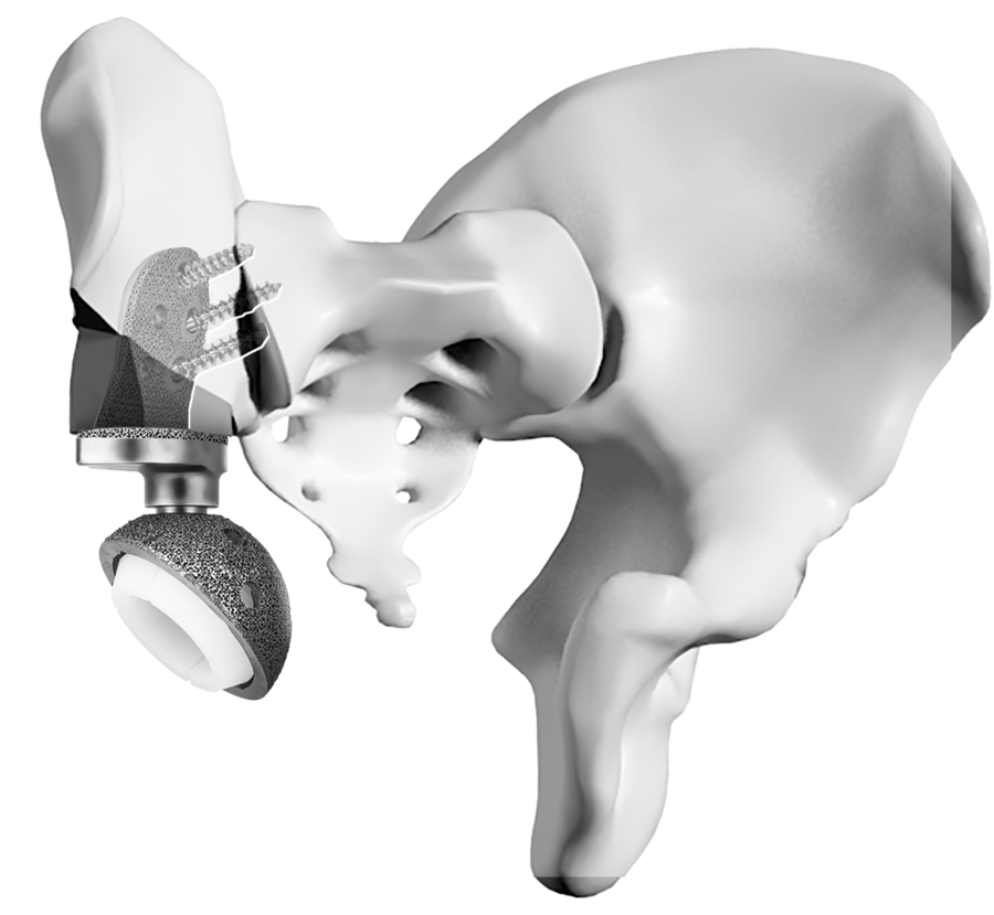 让骨肿瘤患者有尊严地站立——中国"3d打印钛合金组配式人工半骨盆