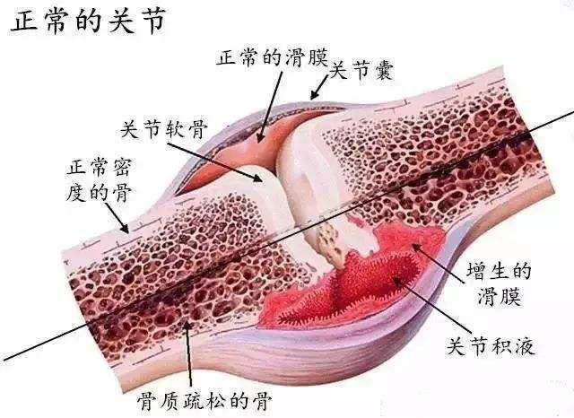 谁说滑膜炎好不了这个方法祛痛消积液很厉害医生也推荐