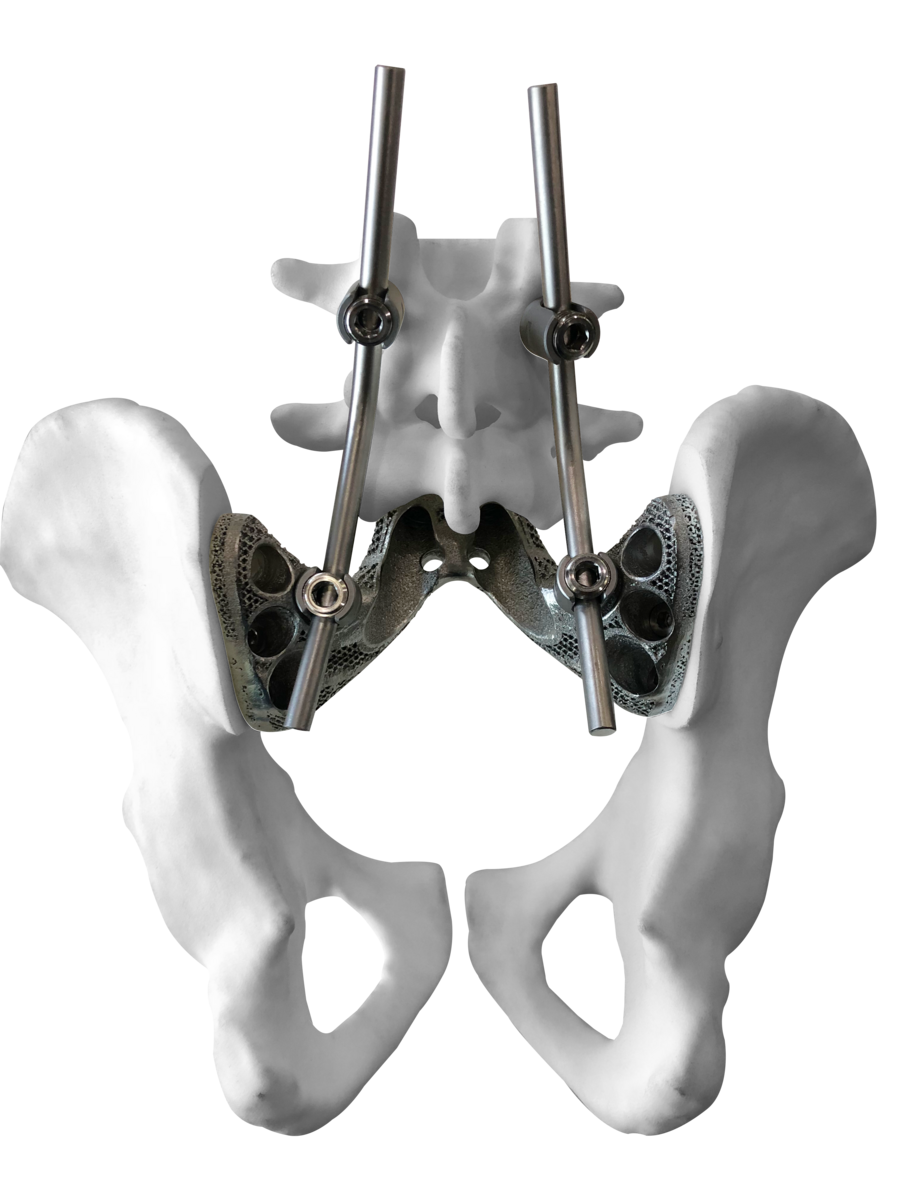 让骨肿瘤患者有尊严地站立——中国"3d打印钛合金组配式人工半骨盆