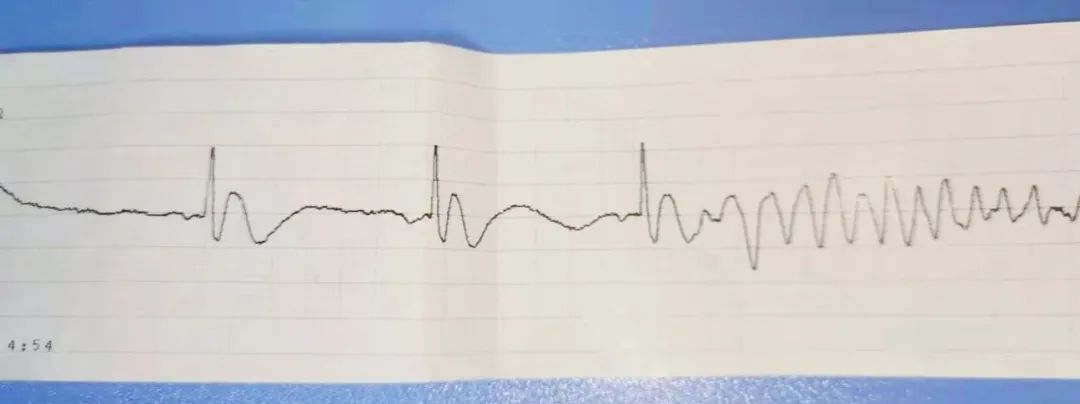 室颤发作持续胸外心脏按压,室速室颤电击除颤4次,困难气道麻醉科