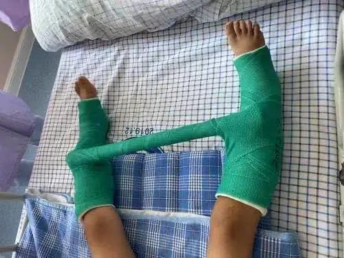 女童摔跤后双腿长度相差5厘米!医生:这是个世界性难题!|石膏_新浪新闻