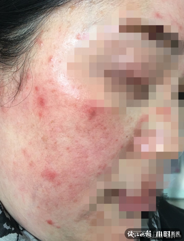 女子突然"烂脸",医生:赶紧停用!