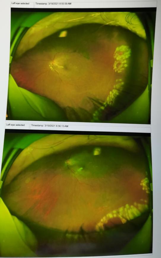 (严先生的术后欧堡眼底照相结果,可看到左眼视网膜复位良好)陈忠平