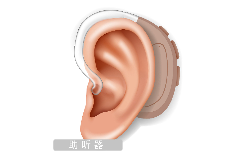 你所关心的人工耳蜗那些事,听听专家怎么说