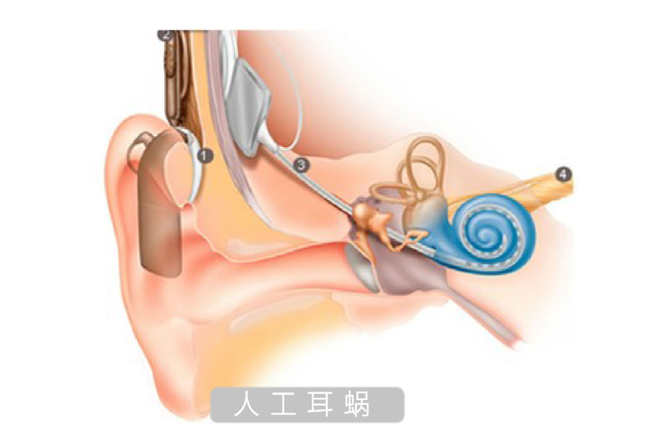 你所关心的人工耳蜗那些事,听听专家怎么说