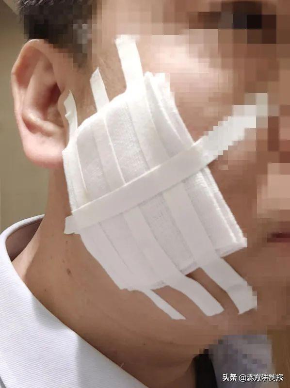 陕西一男子称年会被公司高管烟头烫脸 高管：疼才长记性