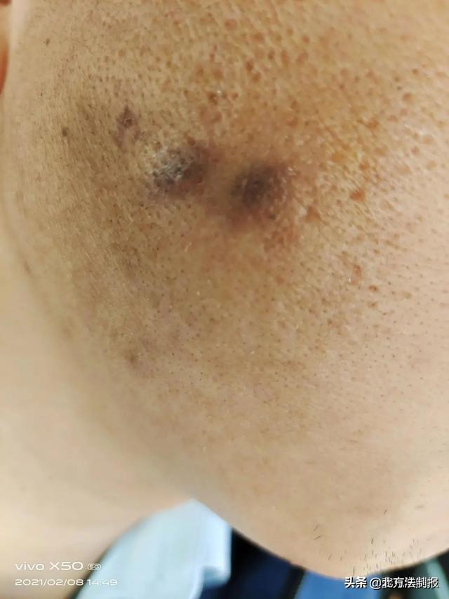 ▲刘先生称，当时两个烟头都是烫在右侧脸颊