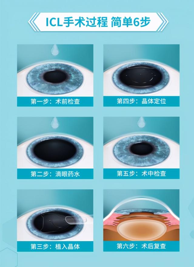 ICL晶体植入手术详解 高度近视矫正十大疑问