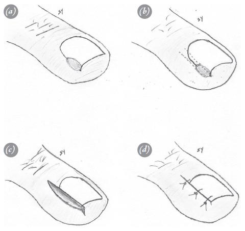 创伤较小,可以最大限度保留甲沟处正常解剖形态