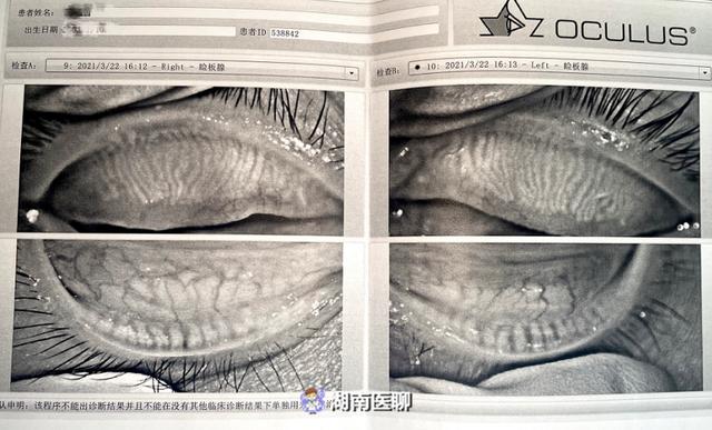 家长警惕干眼症已不是老年病爱玩电子产品的孩子也会中招