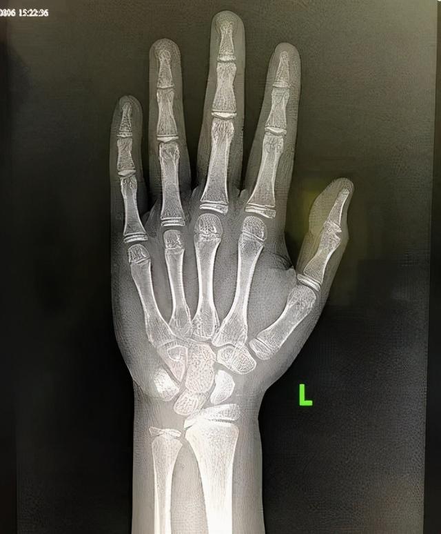 你家孩子长高有点难您的孩子查骨龄了吗