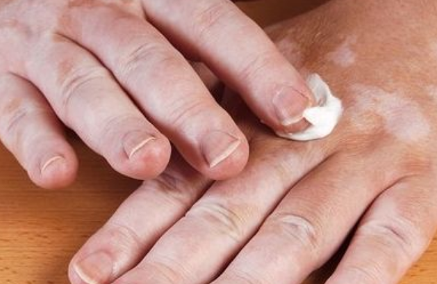 济南治白癜风的医院白癜风如果出现这些症状千万别盲目涂药