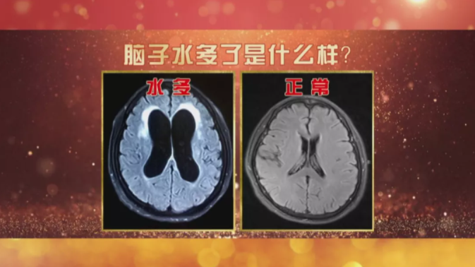 警惕2种异常,保护神经,促进代谢|脑脊液|大脑|水库_新浪新闻