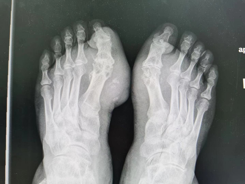 这叫痛风石医生说痛不欲生走路都困难又肿又痛他的双脚拇趾关节周围