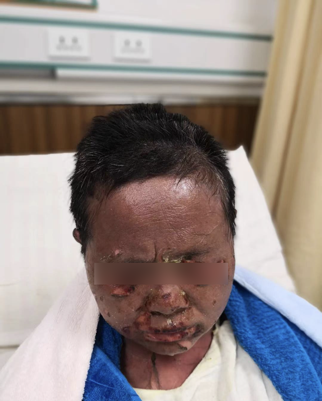 因错误服用癫痫药物过敏突发中毒性表皮坏死松解症,来到江西省皮肤病