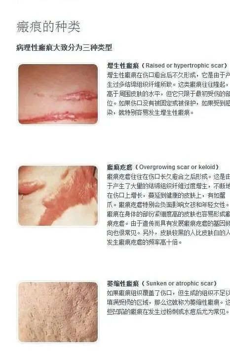 为什么景甜的双眼皮可以修复成富贵花，这大网红花1000万修复还如镰刀砍 