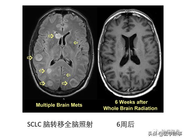 脑转移瘤放疗技术
