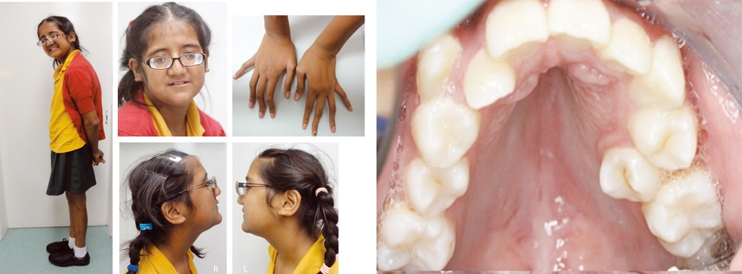 孩子这种长的高可不是好事尤其还有手指细长等问题