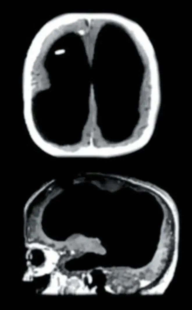 约翰·洛伯对脑水肿患者脑部的扫描图。