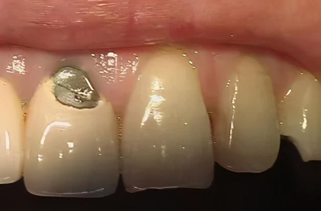 医生,我的烤瓷牙崩瓷了,怎么办?