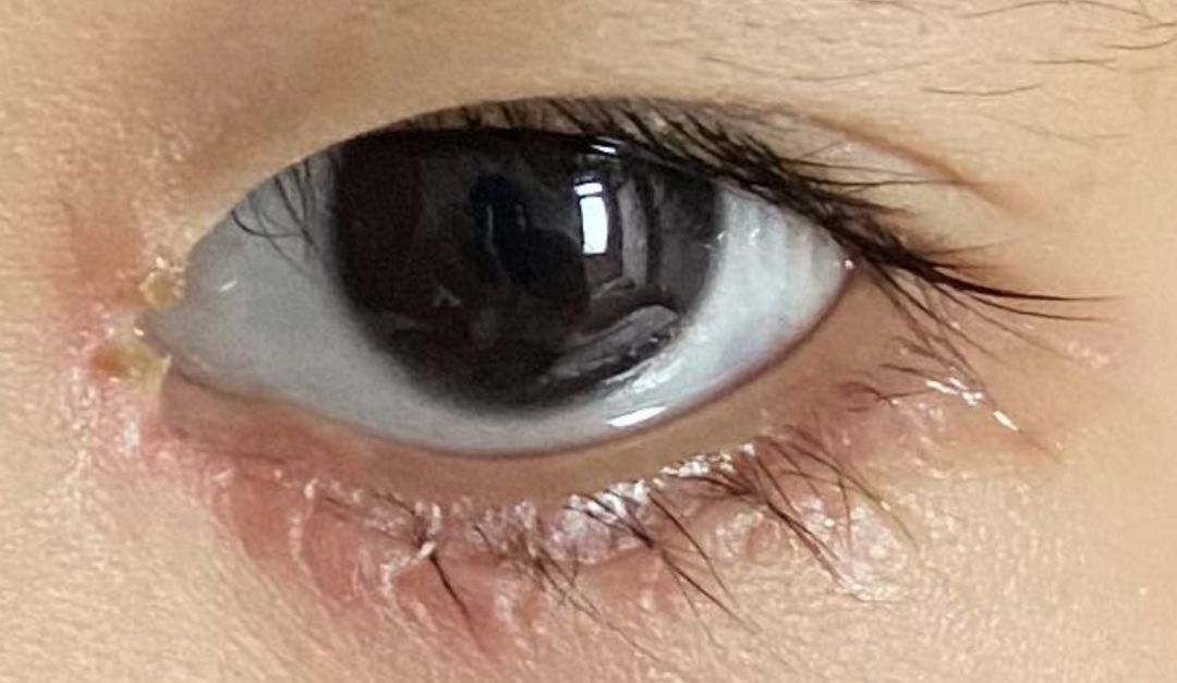 娃的睫毛竟然把自己的眼角膜给戳坏了