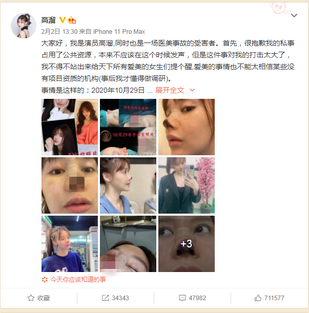 演员高溜此前发文称自己整容失败鼻尖坏死。