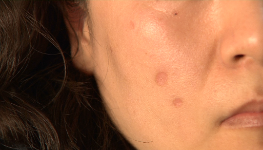 激光祛疤留新疤维权无门谁之过上