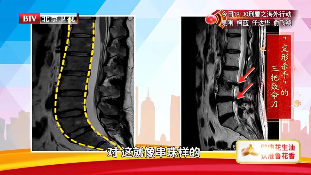 "变形杀手"椎间盘退变 会给身体带来哪些伤害?