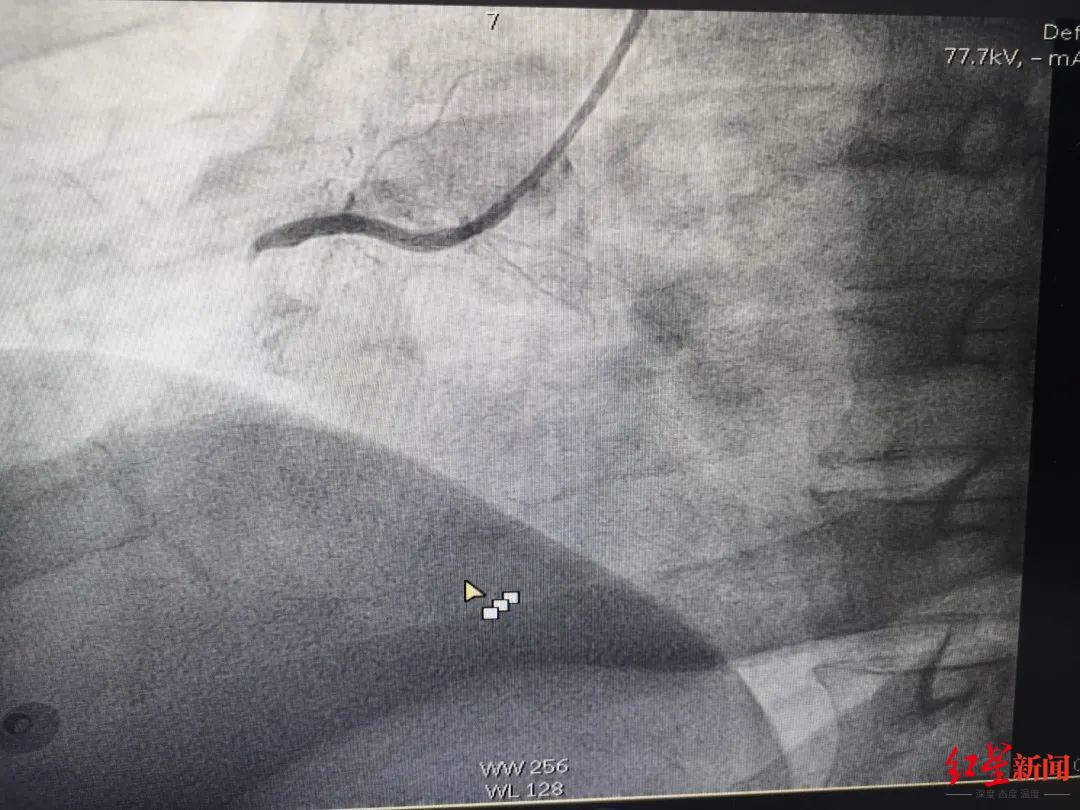 120急救中心专家打120求助心脏骤停20分钟医院以为搞抽查没想到他真
