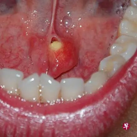 舌下腺发炎图片