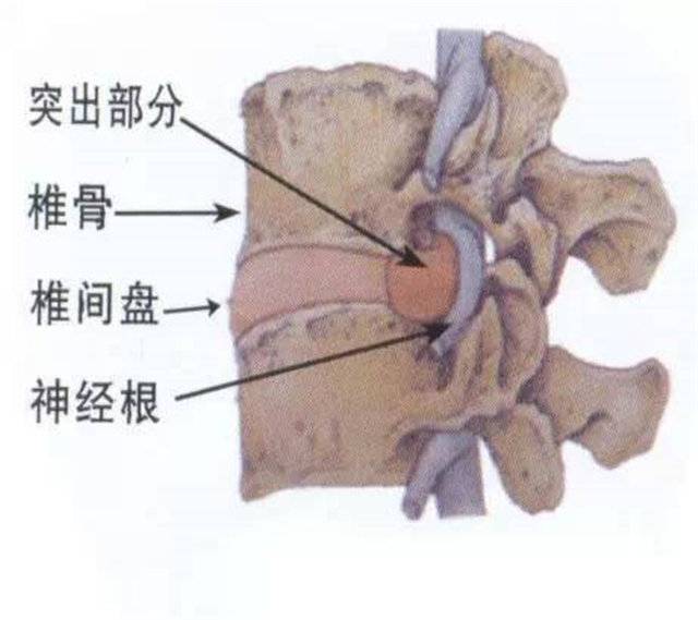腰间盘突出症什么时候需要手术保守治疗能康复吗
