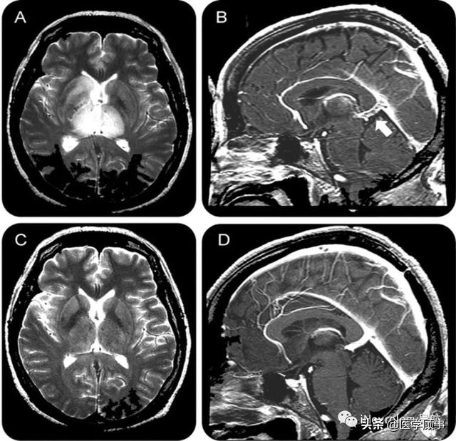 neurology病例:galen静脉血栓形成的可逆性双侧丘脑病变