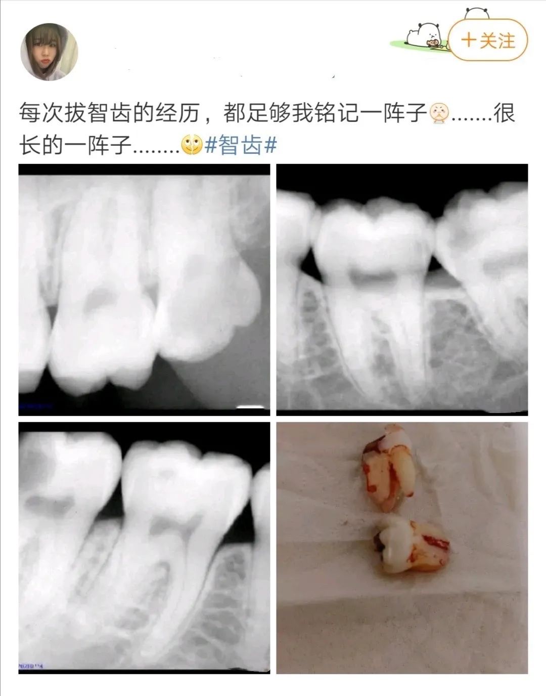 大学生抜智齿是一种什么感觉