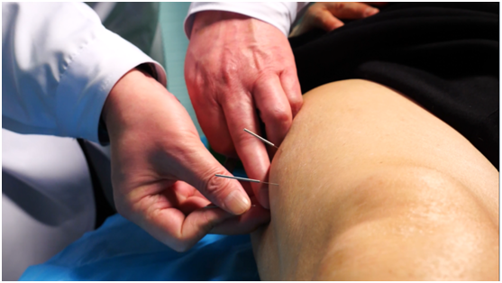 艾灸等,促进膝关节部位的血液循环,消除膝关节内部水肿,从而使半月板