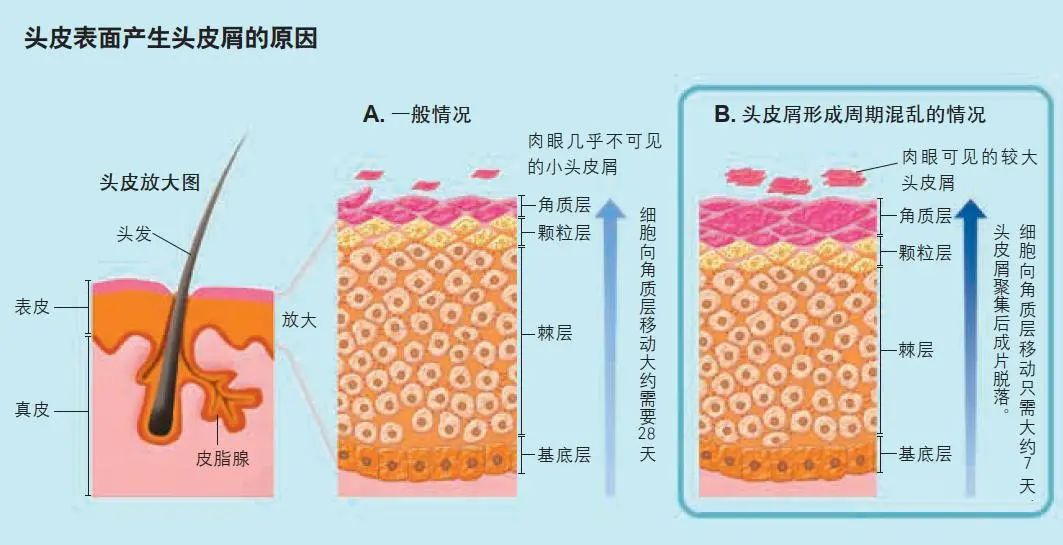 还在为头皮屑烦恼吗它有多种成因对症才能去屑