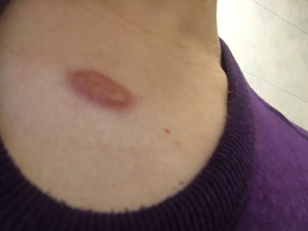 当心皮肤上的小红点它可能摇身一变成为难以去除的肉瘤